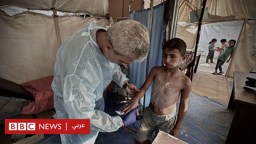 حرب غزة: الأوبئة والأمراض القاتلة التي &quot; تحرق الجلد&quot;  تطارد مليوني نازح  - BBC News عربي